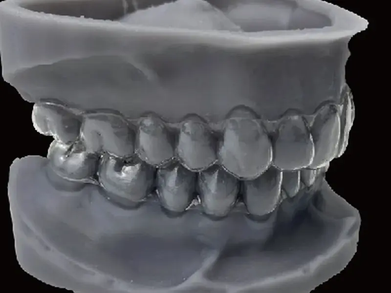 Modèles dentaires d'orthodontie invisible SLA